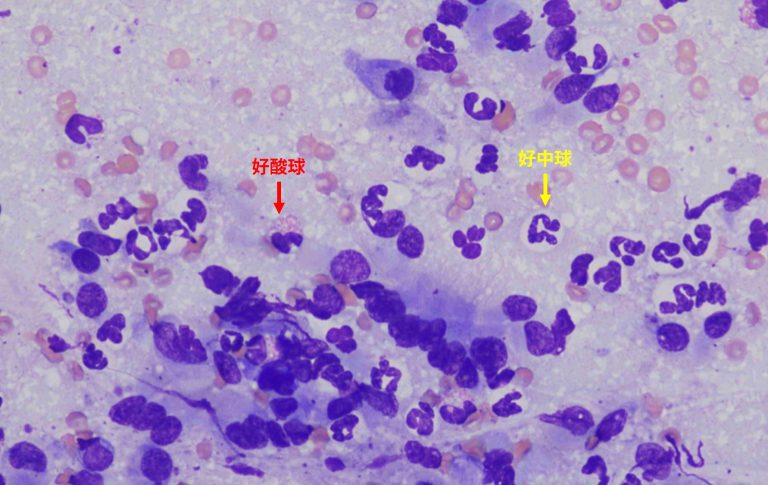 好酸球性気管支炎の治療選択肢